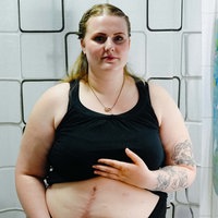 Eine Frau steht im Badezimmer neben einem Spiegel. Sie hat ihr schwarzes Top nach oben gezogen und zeigt ihre Narben am Bauch.