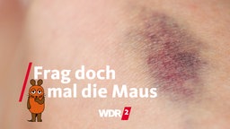 Hämatom auf einem Knie
