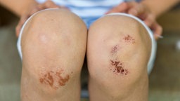 Kinderknie mit blutiger Kruste