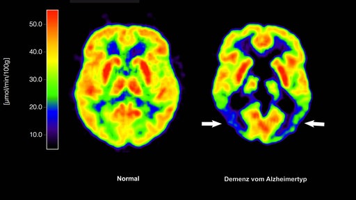 Die mit der Positronen-Emissions- Tomografie (PET) erstellte Abbildung zeigt die Gegenüberstellung zweier Gehirne - im gesunden Zustand (l) und mit Alzheimer-Krankheit 