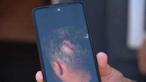 Foto von einer Kopfwunde, die einem Mann mit einem Hammer zugefügt wurde 
