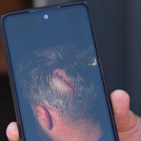 Foto von einer Kopfwunde, die einem Mann mit einem Hammer zugefügt wurde 