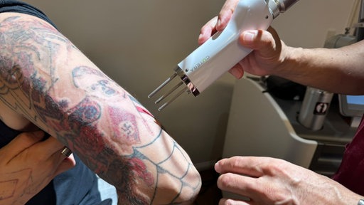 Der linke Arm eines Mannes hat viele Tattoos und ein Laser-Gerät entfernt die