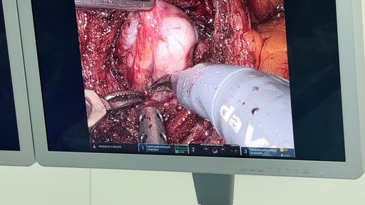 Die Eingriffsinstrumente an den Roboterarment können von den Chirurgen präzise gesteuert werden.