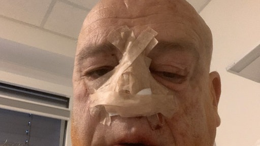 Mann mit verbundener Nase