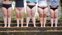 Fünf Frauen, die von Lipödem betroffen sind, stehen auf einer Treppe.