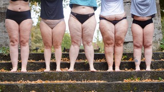 Fünf Frauen, die von Lipödem betroffen sind, stehen auf einer Treppe.