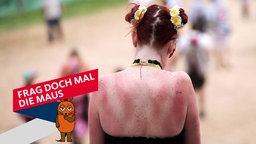 Junge Frau mit sonnenverbranntem Rücken