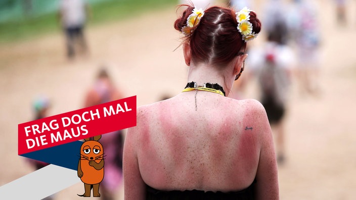 Junge Frau mit sonnenverbranntem Rücken