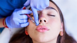 Symbolbild: Eine Frau lässt sich Botox in die obere Lippe spritzen.