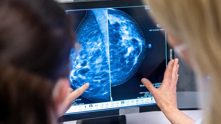 Medizinisches Personal untersucht mit einer Mammografie die Brust einer Frau auf Brustkrebs.