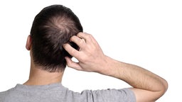 Das Bild zeigt einen Mann mit Haarausfall am Hinterkopf.